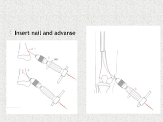  Insert nail and advanse
 