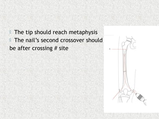 The tip should reach metaphysis
 The nail’s second crossover should
be after crossing # site
 