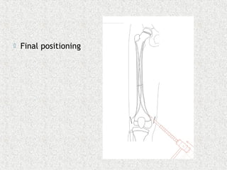  Final positioning
 