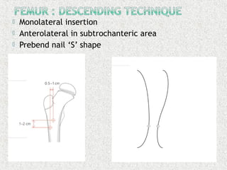  Monolateral insertion
 Anterolateral in subtrochanteric area
 Prebend nail ‘S’ shape
 