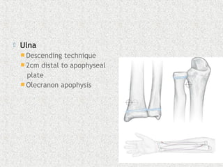  Ulna
 Descending technique
 2cm distal to apophyseal
plate
 Olecranon apophysis
 