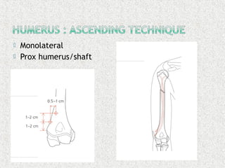  Monolateral
 Prox humerus/shaft
 