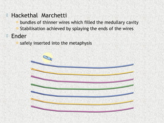  Hackethal Marchetti
 bundles of thinner wires which filled the medullary cavity
 Stabilisation achieved by splaying the ends of the wires
 Ender
 safely inserted into the metaphysis
 