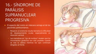 16.- SÍNDROME DE
PARÁLISIS
SUPRANUCLEAR
PROGRESIVA
 El aspecto del rostro en máscara semaja al de los
pacientes parkisonianos.
 Respecto al síndrome resulta llamativa la dificultad
de desplazamiento ocular, especialmente en
dirección vertical.
 Las maniobras en "ojo de muñeca" revelan que los
movimientos giratorios son sólo posibles cuando
se rota la cabeza mientras los ojos continúan
dirigidos al frente.
 