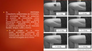  En la MIOTONÍA
CONGÉNITA HEREDITARIA DE THOMSEN,
las anomalías faciales se presentan
en ocasión de movimiento, como
al bostezar; la boca puede
permanecer varios segundos abierta; el
estornudo despierta, a veces,
un espamo prolongado de los músculos
faciales, lengua, cuello y tronco.
 En la imagen se ve cómo
puede permanecer contraídos los
músculos en esta afección; de esta
manera puede ocurrir en la cara y con los
músculos encargados de la mímica.
 