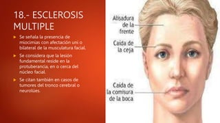 18.- ESCLEROSIS
MULTIPLE
 Se señala la presencia de
miocimias con afectación uni o
bilateral de la musculatura facial.
 Se considera que la lesión
fundamental reside en la
protuberancia, en o cerca del
núcleo facial.
 Se citan también en casos de
tumores del tronco cerebral o
neurolúes.
 