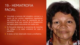 19.- HEMIATROFIA
FACIAL
 Vinculada a tumores del simpático cervical o a
lesión de los centros vegetativos reguladores
del trofismo de la cara, se caracteriza por la
asimetría facial que resulta de la desaparición
del tejido graso subcutáneo de media cara.
 Es frecuente observar la presencia de manchas
de vitíligo, y la caída unilateral de cejas y
pestañas.
 A veces, se han observado miosis y enoftalmia.
 