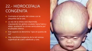 22.- HIDROCEFALIA
CONGÉNITA
 Contrasta el tamaño del cráneo con la
pequeñez de la cara.
 La raíz de la órbita está deprimida,
impulsando los globos oculares hacia fuera y
abajo, quedando la córnea semicubierta por
el párpado inferior.
 Este aspecto se denomina "ojos en puesta de
sol"
 Hay manifiesta turgencia de la red venosa
superficial de cuero cabelludo y cara.
 