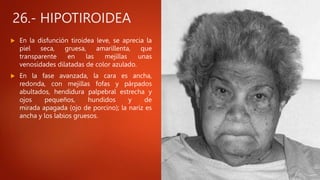 26.- HIPOTIROIDEA
 En la disfunción tiroidea leve, se aprecia la
piel seca, gruesa, amarillenta, que
transparente en las mejillas unas
venosidades dilatadas de color azulado.
 En la fase avanzada, la cara es ancha,
redonda, con mejillas fofas y párpados
abultados, hendidura palpebral estrecha y
ojos pequeños, hundidos y de
mirada apagada (ojo de porcino); la nariz es
ancha y los labios gruesos.
 