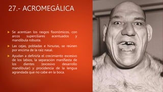 27.- ACROMEGÁLICA
 Se acentúan los rasgos fisonómicos, con
arcos superciliares acentuados y
mandíbula robusta.
 Las cejas, pobladas e hirsutas, se reúnen
por encima de la raíz nasal.
 Ayudan a definirla el crecimiento excesivo
de los labios, la separación manifiesta de
los dientes (excesivo desarrollo
mandibular) y procidencia de la lengua
agrandada que no cabe en la boca.
 
