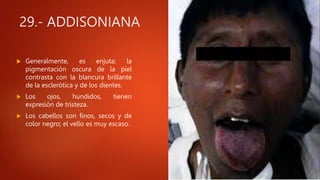 29.- ADDISONIANA
 Generalmente, es enjuta; la
pigmentación oscura de la piel
contrasta con la blancura brillante
de la esclerótica y de los dientes.
 Los ojos, hundidos, tienen
expresión de tristeza.
 Los cabellos son finos, secos y de
color negro; el vello es muy escaso.
 