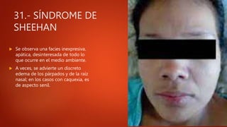 31.- SÍNDROME DE
SHEEHAN
 Se observa una facies inexpresiva,
apática, desinteresada de todo lo
que ocurre en el medio ambiente.
 A veces, se advierte un discreto
edema de los párpados y de la raíz
nasal; en los casos con caquexia, es
de aspecto senil.
 