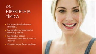 34.-
HIPERTROFIA
TÍMICA
 La cara está delicadamente
modelada.
 Los cabellos son abundantes,
sedosos y rizados.
 Las mejillas, tersas y
sonrosadas, cambian fácilmente
de color.
 Pestañas largas (facies angélica).
 