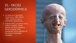 35.- FACIES
GERODÉRMICA
 Se observa en laprogeria
(Hutchinson, 1886; Gilford,
1897), enanismo senil o
infantilismo gerodérmico.
 Aspecto senil, con calvicie más o
menos completo, cráneo
grande, piel seca y pardusca,
frente arrugada, venas
promientes, cierre retardado de
las suturas y fontanelas
craneales.
 