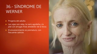 36.- SÍNDROME DE
WERNER
 Progeria del adulto.
 Las cejas son ralas, la nariz aguileña y la
piel con arrugas finas alrededor de la boca.
 El encanecimiento es prematuro, con
frecuente calvicie.
 