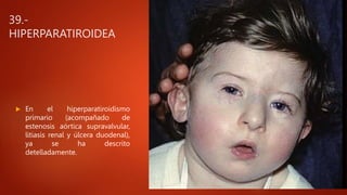 39.-
HIPERPARATIROIDEA
 En el hiperparatiroidismo
primario (acompañado de
estenosis aórtica supravalvular,
litiasis renal y úlcera duodenal),
ya se ha descrito
detelladamente.
 