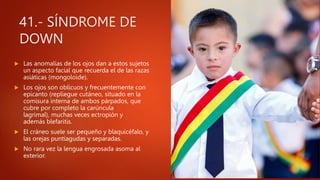 41.- SÍNDROME DE
DOWN
 Las anomalías de los ojos dan a estos sujetos
un aspecto facial que recuerda el de las razas
asiáticas (mongoloide).
 Los ojos son oblicuos y frecuentemente con
epicanto (repliegue cutáneo, situado en la
comisura interna de ambos párpados, que
cubre por completo la carúncula
lagrimal), muchas veces ectropión y
además blefaritis.
 El cráneo suele ser pequeño y blaquicéfalo, y
las orejas puntiagudas y separadas.
 No rara vez la lengua engrosada asoma al
exterior.
 
