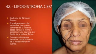 42.- LIPODISTROFIA CEFALOTORÁCIA
 Síndrome de Barraquer-
Simons
 El adelgazamiento del
semblante, que puede
comenzar en la infancia,
acaba por dar al rostro el
aspecto de una calavera, por
fusión de la bola de Bichat.
 Contrasta, de manera
llamativa, con la polisarcia
de la mitad inferior del
cuerpo.
 