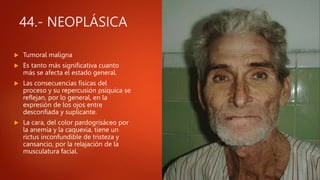 44.- NEOPLÁSICA
 Tumoral maligna
 Es tanto más significativa cuanto
más se afecta el estado general.
 Las consecuencias físicas del
proceso y su repercusión psíquica se
reflejan, por lo general, en la
expresión de los ojos entre
desconfiada y suplicante.
 La cara, del color pardogrisáceo por
la anemia y la caquexia, tiene un
rictus inconfundible de tristeza y
cansancio, por la relajación de la
musculatura facial.
 