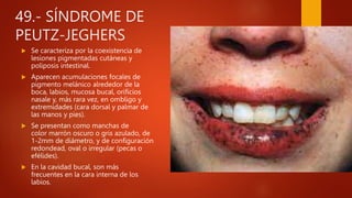 49.- SÍNDROME DE
PEUTZ-JEGHERS
 Se caracteriza por la coexistencia de
lesiones pigmentadas cutáneas y
poliposis intestinal.
 Aparecen acumulaciones focales de
pigmento melánico alrededor de la
boca, labios, mucosa bucal, orificios
nasale y, más rara vez, en ombligo y
extremidades (cara dorsal y palmar de
las manos y pies).
 Se presentan como manchas de
color marrón oscuro o gris azulado, de
1-2mm de diámetro, y de configuración
redondead, oval o irregular (pecas o
efélides).
 En la cavidad bucal, son más
frecuentes en la cara interna de los
labios.
 