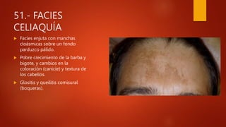 51.- FACIES
CELIAQUÍA
 Facies enjuta con manchas
cloásmicas sobre un fondo
parduzco pálido.
 Pobre crecimiento de la barba y
bigote, y cambios en la
coloración (canicie) y textura de
los cabellos.
 Glositis y queilitis comisural
(boqueras).
 