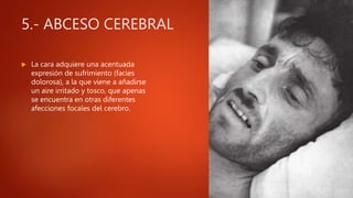 5.- ABCESO CEREBRAL
 La cara adquiere una acentuada
expresión de sufrimiento (facies
dolorosa), a la que viene a añadirse
un aire irritado y tosco, que apenas
se encuentra en otras diferentes
afecciones focales del cerebro.
 