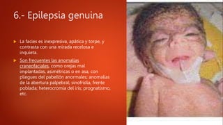 6.- Epilepsia genuina
 La facies es inexpresiva, apática y torpe, y
contrasta con una mirada recelosa e
inquieta.
 Son frecuentes las anomalías
craneofaciales, como orejas mal
implantadas, asimétricas o en asa, con
pliegues del pabellón anormales; anomalías
de la abertura palpebral; sinofridia, frente
poblada; heterocromía del iris; prognatismo,
etc.
 