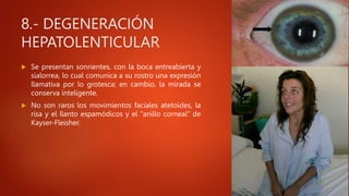 8.- DEGENERACIÓN
HEPATOLENTICULAR
 Se presentan sonrientes, con la boca entreabierta y
sialorrea, lo cual comunica a su rostro una expresión
llamativa por lo grotesca; en cambio, la mirada se
conserva inteligente.
 No son raros los movimientos faciales atetoides, la
risa y el llanto espamódicos y el "anillo corneal" de
Kayser-Fleisher.
 