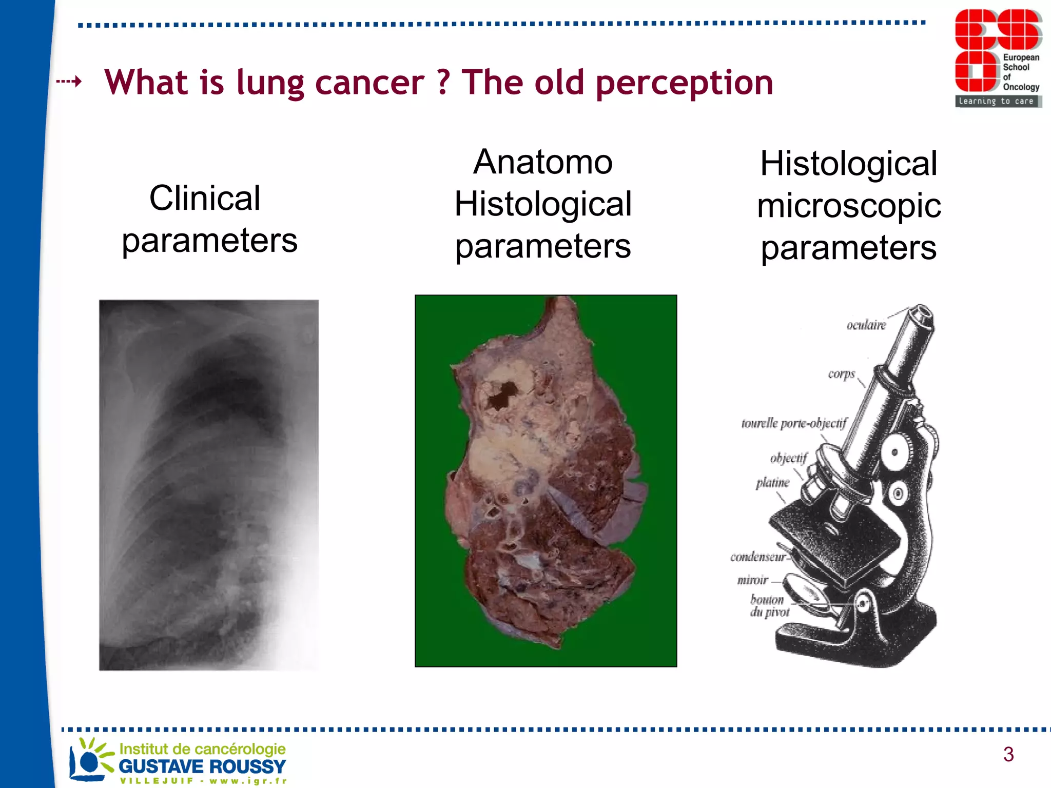 What is lung cancer ? The old perception Clinical  parameters Anatomo Histological parameters Histological microscopic parameters 