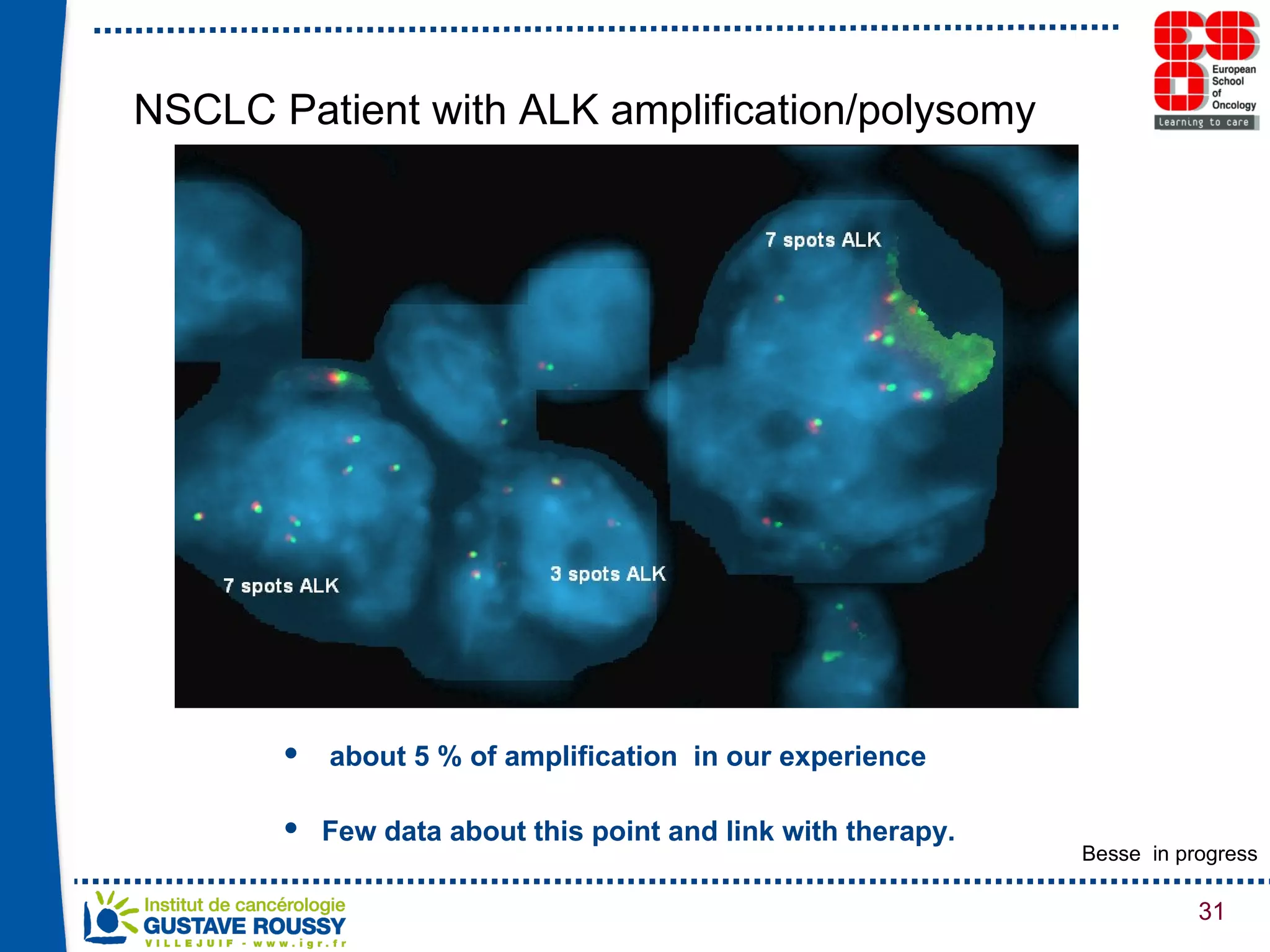 NSCLC Patient with ALK amplification/polysomy about 5 % of amplification  in our experience Few data about this point and link with therapy. Besse  in progress 