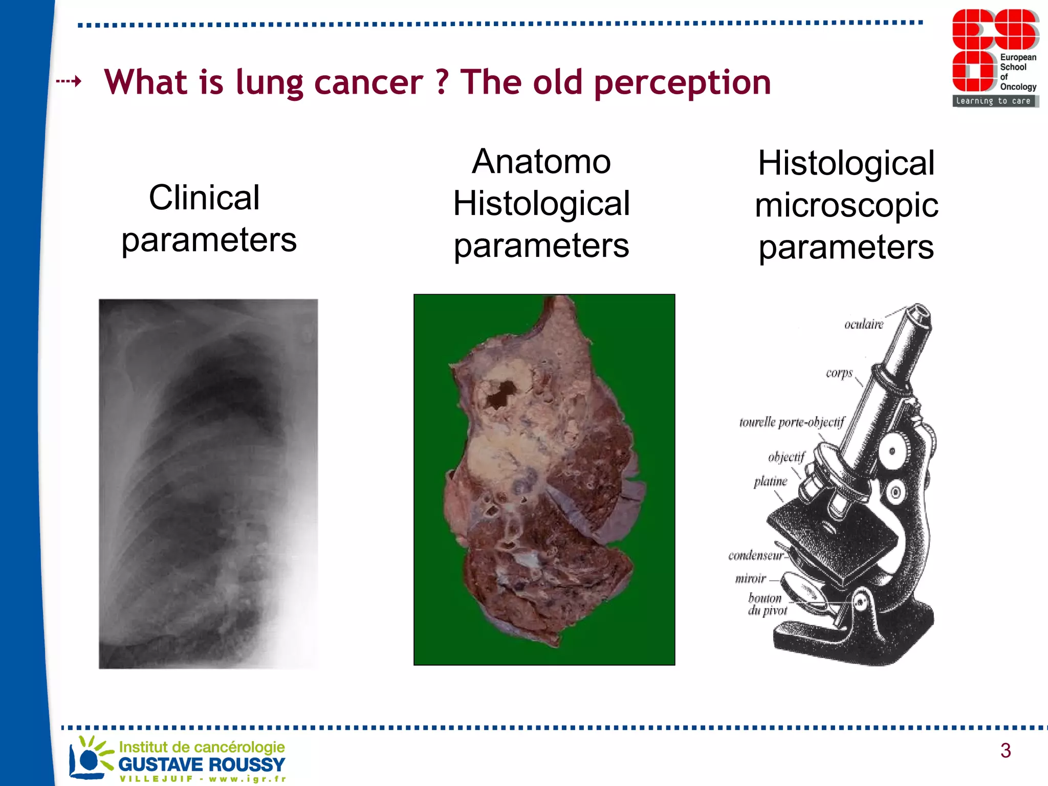 What is lung cancer ? The old perception Clinical  parameters Anatomo Histological parameters Histological microscopic parameters 