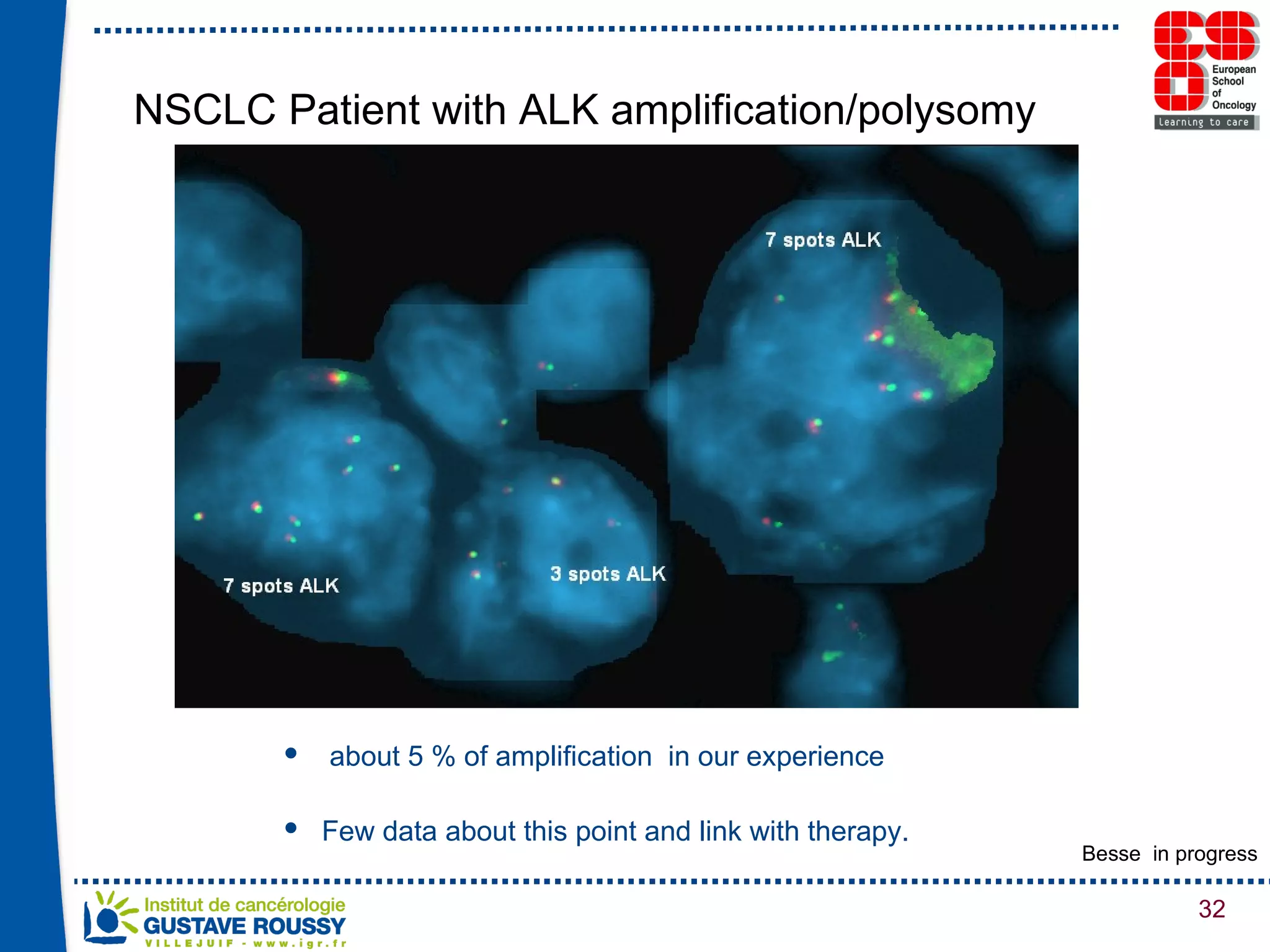 NSCLC Patient with ALK amplification/polysomy about 5 % of amplification  in our experience Few data about this point and link with therapy. Besse  in progress 