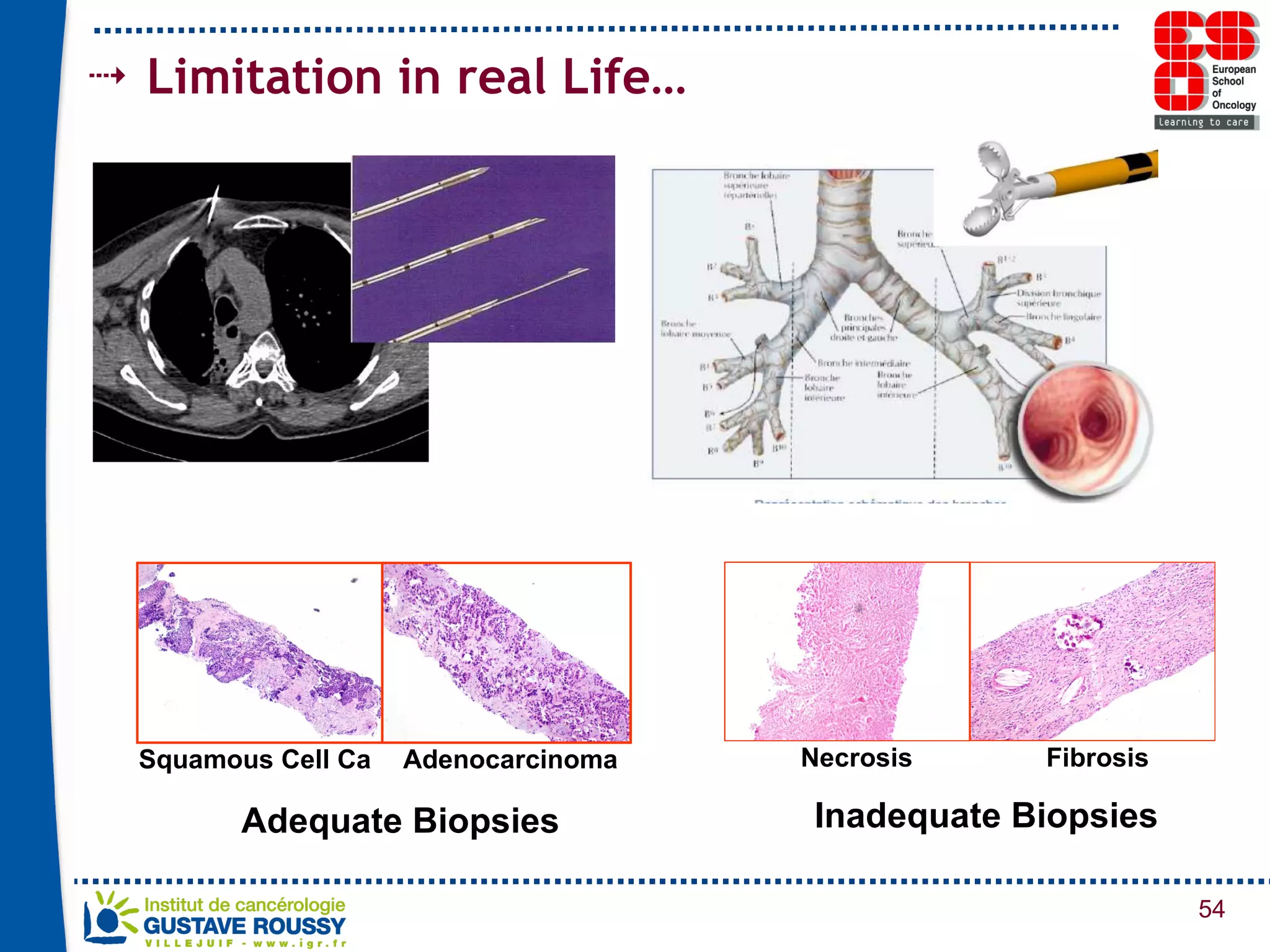 Limitation in real Life… Adequate Biopsies  Inadequate Biopsies  Squamous Cell Ca Adenocarcinoma Necrosis Fibrosis 