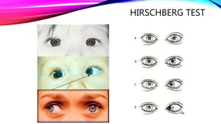 Hirschberg Test Normal ESODEVIATION AND ITS APPROACH.pptx
