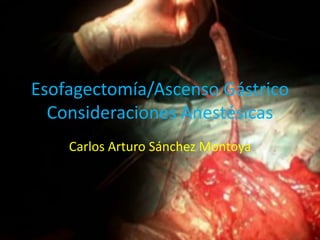 Esofagectomía/Ascenso Gástrico
Consideraciones Anestésicas
Carlos Arturo Sánchez Montoya
 
