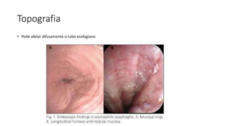 Topografia
• Pode afetar difusamente o tubo esofagiano
 