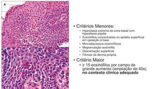 • Critérios Menores:
• Hiperplasia extrema da zona basal com
hiperplasia papilar
• Eosinófilos concentrados no epitélio superficial
em oposição à base
• Microabscessos eosinofílicos
• Megranulação eosinófila
• Descamação superficial
• Fibrose da lâmina própria
• Critério Maior
• ≥ 15 eosinófilos por campo de
grande aumento (ampliação de 40x)
no contexto clínico adequado
 
