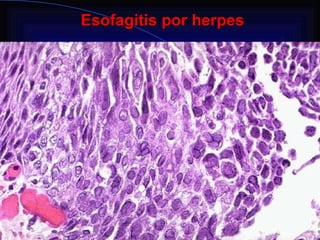 Esofagitis por herpes                                                      