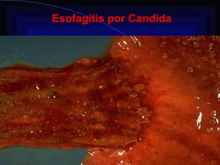 Esofagitis por Candida                                                      