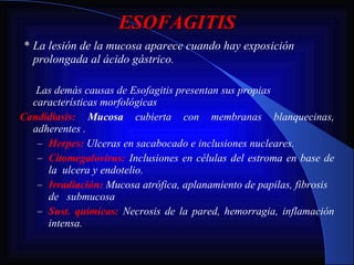 ESOFAGITIS   *  La lesión de la mucosa aparece cuando hay exposición prolongada al ácido gástrico.    Las demás causas de Esofagitis presentan sus propias características morfológicas Candidiasis:  Mucosa  cubierta con membranas blanquecinas, adherentes . Herpes:  Ulceras en sacabocado e inclusiones nucleares. Citomegalovirus:  Inclusiones en células del estroma en base de la  ulcera y endotelio. Irradiación:   Mucosa atrófica, aplanamiento de papilas, fibrosis de  submucosa  Sust. químicas:   Necrosis de la pared, hemorragia, inflamación intensa. 