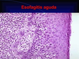 Esofagitis aguda 