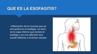 QUE ES LA ESOFAGITIS?
 Inflamación de la mucosa que se
encuentra en el esófago, es decir,
de la capa interna que reviste el
esófago y es una afección que
puede deberse a diversas causas.
 