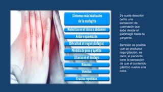 Se suele describir
como una
sensación de
quemazón que
sube desde el
estómago hasta la
garganta.
También es posible
que se produzca
regurgitación, es
decir, el paciente
tiene la sensación
de que el contenido
gástrico vuelve a la
boca.
 