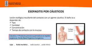 ESOFAGITIS | PPTX