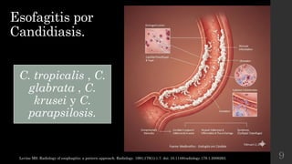 esofagitis abordaje radiológico en diferentes modalidades.pptx