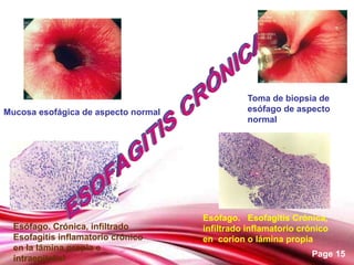 Tema esofagitis tema para exponer en clase | PPT