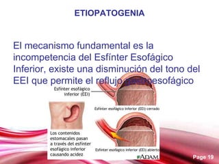 Tema esofagitis tema para exponer en clase | PPT