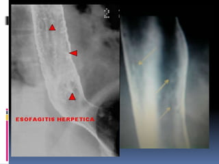 Esofagitis diapos | PPTX