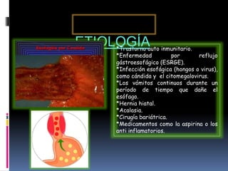 Esofagitis diapos | PPTX