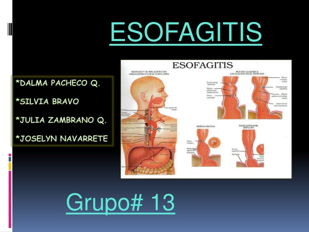 Esofagatis Esofagitis En Espaol : Esofagitis: tipos, síntomas y tratamiento – WKRQA